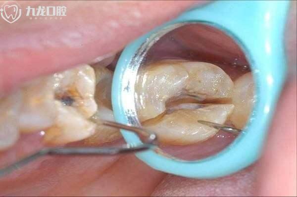 牙齿有个黑洞痛疼怎么办？